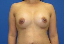 Breast Augmentation After Photo by Katerina Gallus, MD, FACS; San Diego, CA - Case 45235