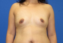 Breast Augmentation Before Photo by Katerina Gallus, MD, FACS; San Diego, CA - Case 45235