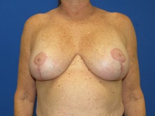 Breast Implant Revision After Photo by Katerina Gallus, MD, FACS; San Diego, CA - Case 45236