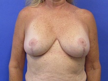Breast Implant Revision Before Photo by Katerina Gallus, MD, FACS; San Diego, CA - Case 45236