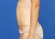 Tummy Tuck After Photo by Katerina Gallus, MD, FACS; San Diego, CA - Case 45240