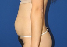 Tummy Tuck Before Photo by Katerina Gallus, MD, FACS; San Diego, CA - Case 45240