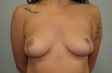 Breast Reduction After Photo by Katerina Gallus, MD, FACS; San Diego, CA - Case 45242