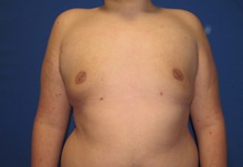 Male Breast Reduction After Photo by Katerina Gallus, MD, FACS; San Diego, CA - Case 45247