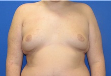 Male Breast Reduction Before Photo by Katerina Gallus, MD, FACS; San Diego, CA - Case 45247