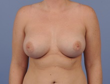 Breast Augmentation After Photo by Katerina Gallus, MD, FACS; San Diego, CA - Case 45250