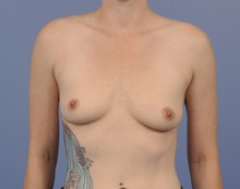 Breast Augmentation Before Photo by Katerina Gallus, MD, FACS; San Diego, CA - Case 45252