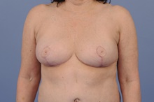 Breast Reduction After Photo by Katerina Gallus, MD, FACS; San Diego, CA - Case 45255