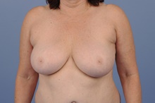 Breast Reduction Before Photo by Katerina Gallus, MD, FACS; San Diego, CA - Case 45255