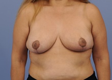 Breast Reduction After Photo by Katerina Gallus, MD, FACS; San Diego, CA - Case 45256