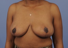 Breast Reduction After Photo by Katerina Gallus, MD, FACS; San Diego, CA - Case 45258