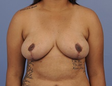 Breast Reduction After Photo by Katerina Gallus, MD, FACS; San Diego, CA - Case 45259