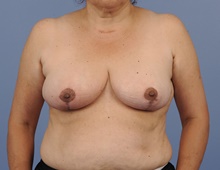 Breast Reduction After Photo by Katerina Gallus, MD, FACS; San Diego, CA - Case 45263