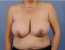 Breast Reduction Before Photo by Katerina Gallus, MD, FACS; San Diego, CA - Case 45263