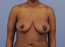 Breast Reduction After Photo by Katerina Gallus, MD, FACS; San Diego, CA - Case 45264