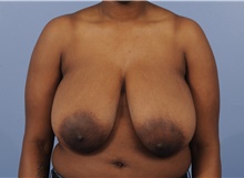 Breast Reduction Before Photo by Katerina Gallus, MD, FACS; San Diego, CA - Case 45264