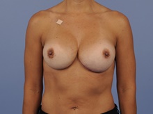 Breast Implant Revision After Photo by Katerina Gallus, MD, FACS; San Diego, CA - Case 45269