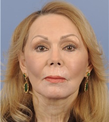 Facelift After Photo by Katerina Gallus, MD, FACS; San Diego, CA - Case 45271