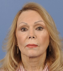 Facelift Before Photo by Katerina Gallus, MD, FACS; San Diego, CA - Case 45271