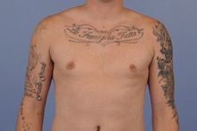Male Breast Reduction After Photo by Katerina Gallus, MD, FACS; San Diego, CA - Case 45273