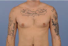 Male Breast Reduction Before Photo by Katerina Gallus, MD, FACS; San Diego, CA - Case 45273