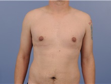 Male Breast Reduction After Photo by Katerina Gallus, MD, FACS; San Diego, CA - Case 45274