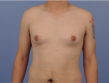 Male Breast Reduction Before Photo by Katerina Gallus, MD, FACS; San Diego, CA - Case 45274