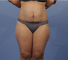 Tummy Tuck Before Photo by Katerina Gallus, MD, FACS; San Diego, CA - Case 45295