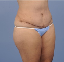 Tummy Tuck After Photo by Katerina Gallus, MD, FACS; San Diego, CA - Case 45295