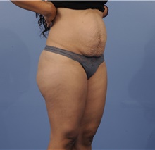 Tummy Tuck Before Photo by Katerina Gallus, MD, FACS; San Diego, CA - Case 45295