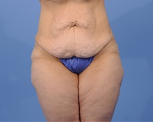 Tummy Tuck Before Photo by Katerina Gallus, MD, FACS; San Diego, CA - Case 45296