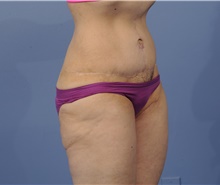 Tummy Tuck After Photo by Katerina Gallus, MD, FACS; San Diego, CA - Case 45296