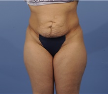Tummy Tuck Before Photo by Katerina Gallus, MD, FACS; San Diego, CA - Case 45297
