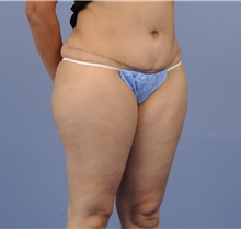 Tummy Tuck After Photo by Katerina Gallus, MD, FACS; San Diego, CA - Case 45297