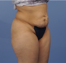 Tummy Tuck Before Photo by Katerina Gallus, MD, FACS; San Diego, CA - Case 45297