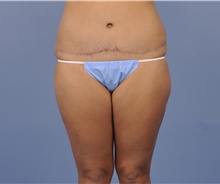 Tummy Tuck After Photo by Katerina Gallus, MD, FACS; San Diego, CA - Case 45300