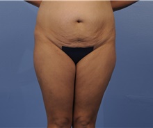 Tummy Tuck Before Photo by Katerina Gallus, MD, FACS; San Diego, CA - Case 45300