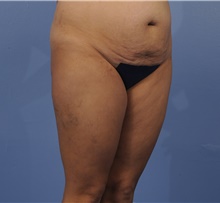 Tummy Tuck Before Photo by Katerina Gallus, MD, FACS; San Diego, CA - Case 45300