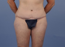 Tummy Tuck After Photo by Katerina Gallus, MD, FACS; San Diego, CA - Case 45301
