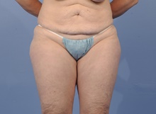 Tummy Tuck Before Photo by Katerina Gallus, MD, FACS; San Diego, CA - Case 45301