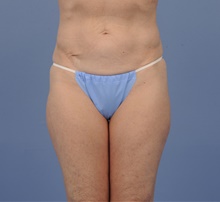 Tummy Tuck Before Photo by Katerina Gallus, MD, FACS; San Diego, CA - Case 45304