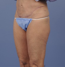 Tummy Tuck After Photo by Katerina Gallus, MD, FACS; San Diego, CA - Case 45304
