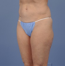 Tummy Tuck Before Photo by Katerina Gallus, MD, FACS; San Diego, CA - Case 45304