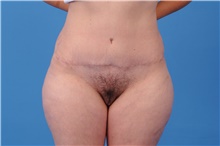 Tummy Tuck After Photo by Katerina Gallus, MD, FACS; San Diego, CA - Case 45309