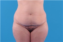 Tummy Tuck Before Photo by Katerina Gallus, MD, FACS; San Diego, CA - Case 45309
