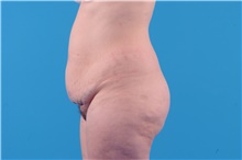 Tummy Tuck Before Photo by Katerina Gallus, MD, FACS; San Diego, CA - Case 45309