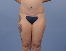 Tummy Tuck After Photo by Katerina Gallus, MD, FACS; San Diego, CA - Case 45317