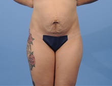 Tummy Tuck Before Photo by Katerina Gallus, MD, FACS; San Diego, CA - Case 45317