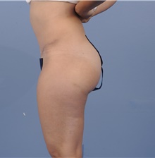 Tummy Tuck After Photo by Katerina Gallus, MD, FACS; San Diego, CA - Case 45317