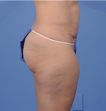 Tummy Tuck After Photo by Katerina Gallus, MD, FACS; San Diego, CA - Case 45321